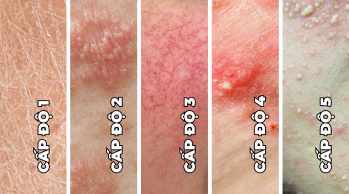 Các cấp độ gây hại trên da của Corticoid